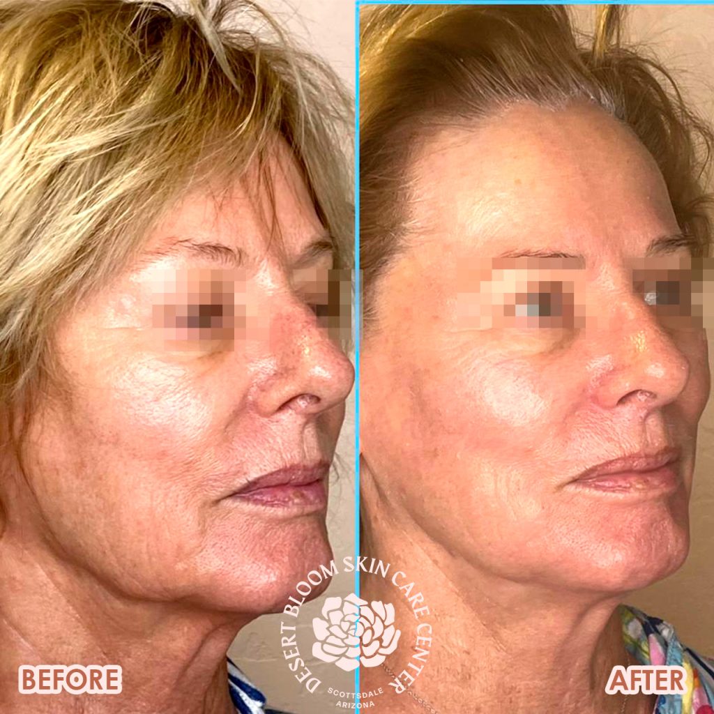 before & after | PDO-thread-lift | mid-face | profile-right