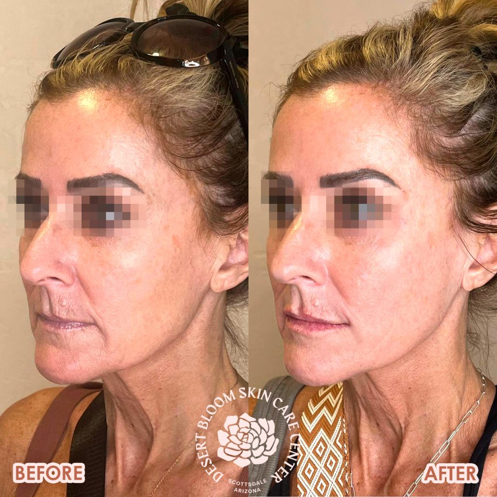 before & after | PDO-thread-lift | profile-left