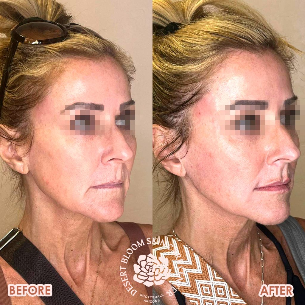 before & after | PDO-thread-lift | profile-right