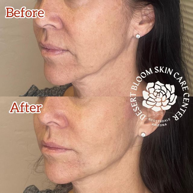 before & after | PDO thread lift with @pdomax mid face | jowls | profile left