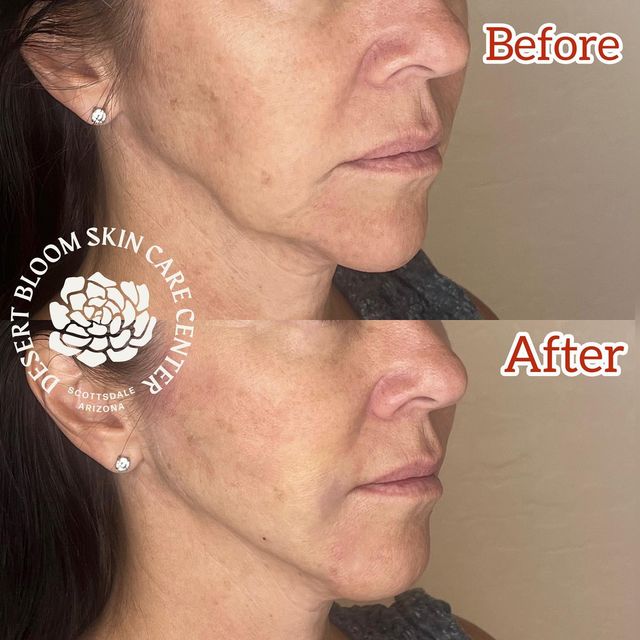 before & after | PDO thread lift with @pdomax mid face | jowls | profile right