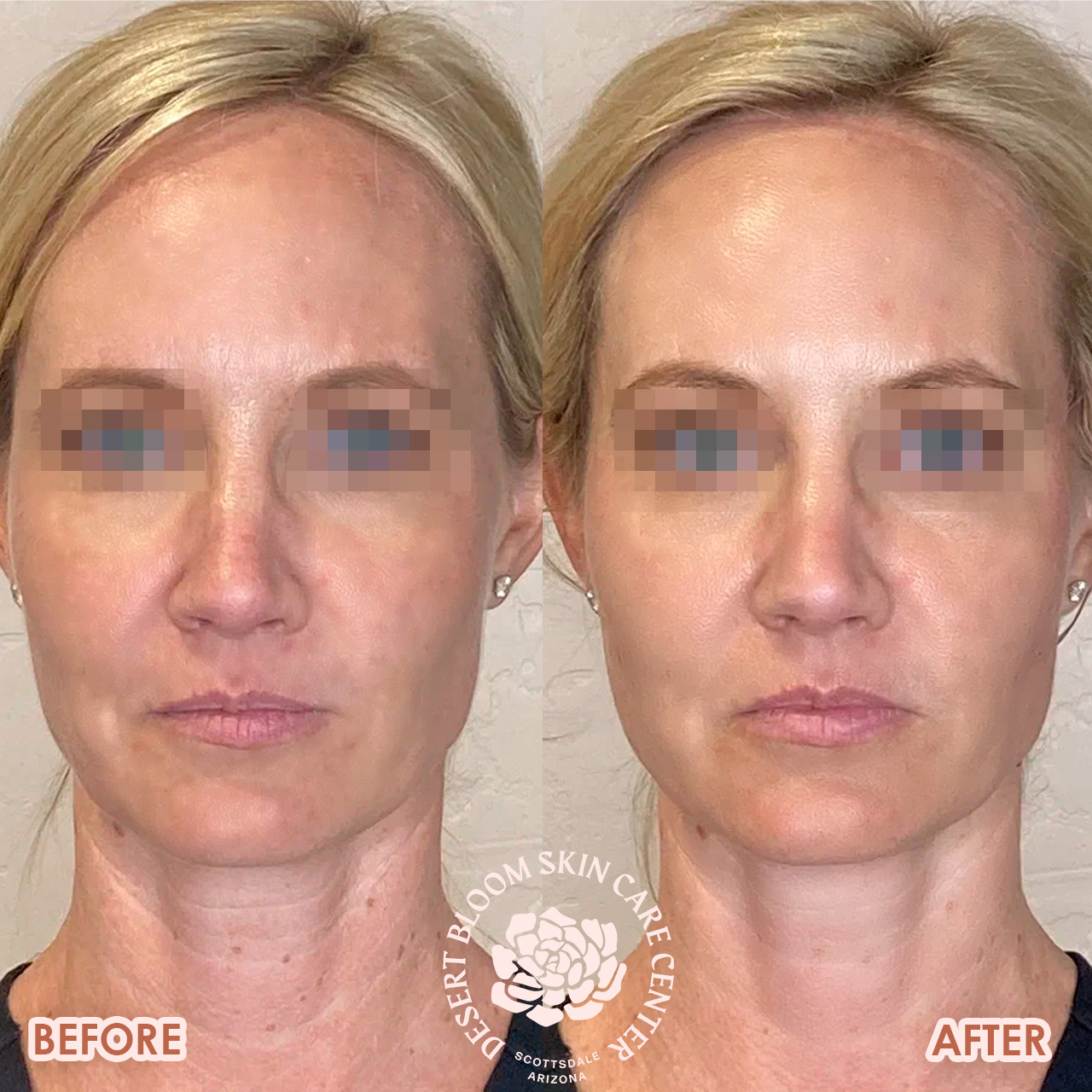 thread-face-lift-before-after-photo