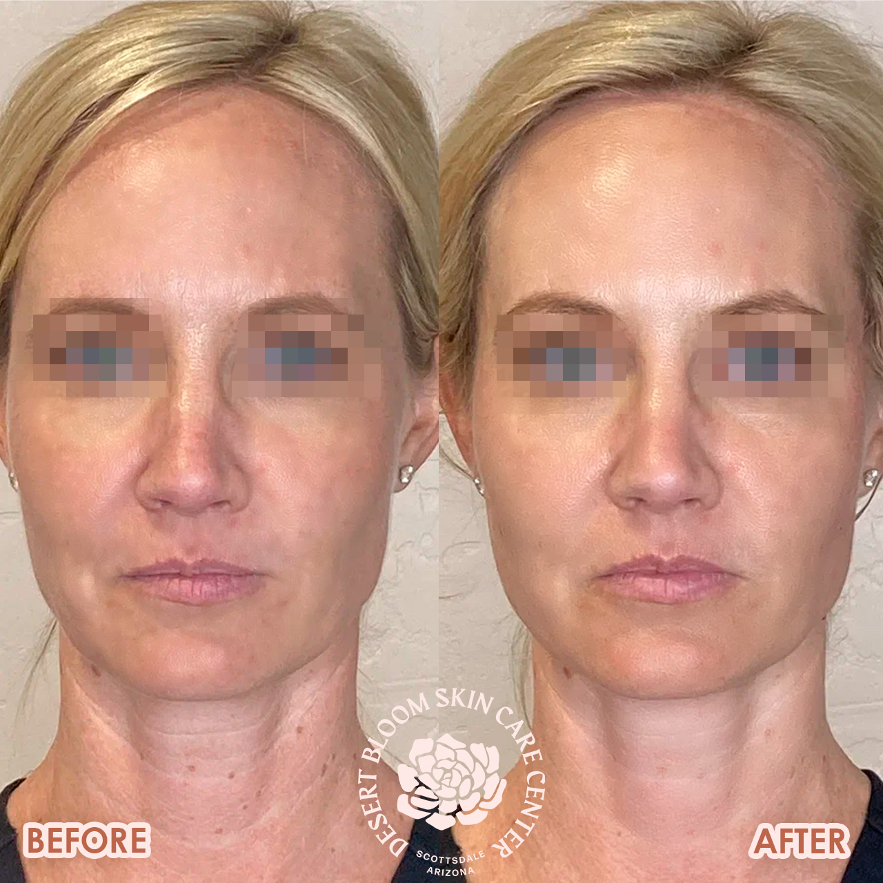 thread-face-lift-before-after-photo