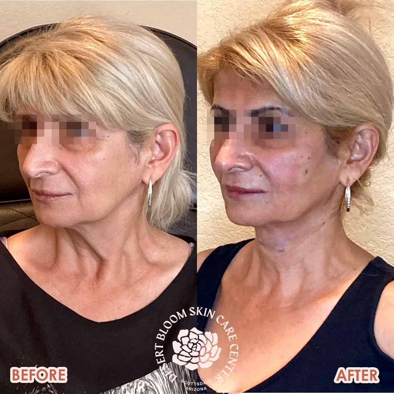 threading-face-lift-before-after-photo-left