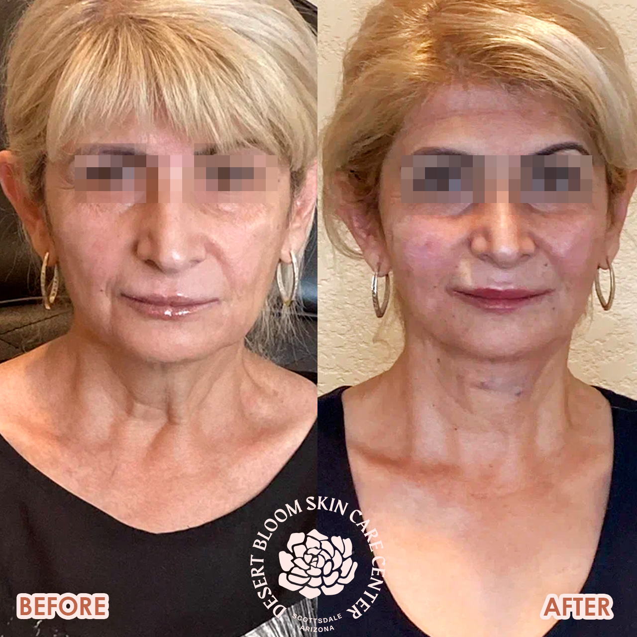 threading-face-lift-before-after-photo