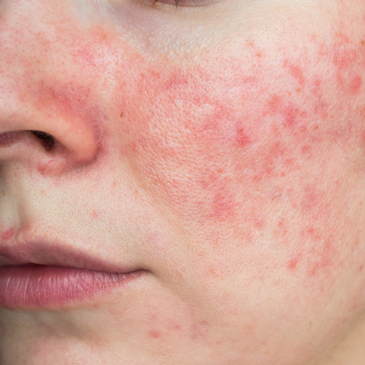 Rosacea