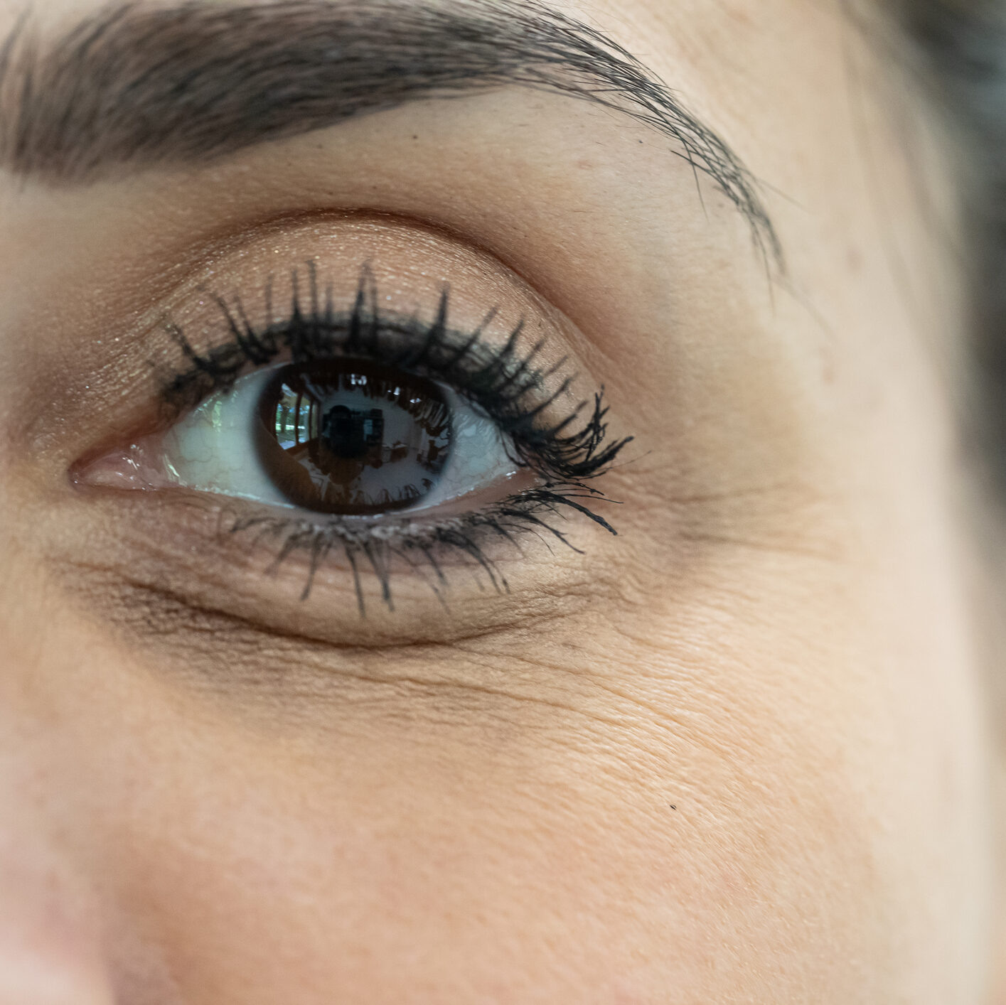 Close-up of lateral periorbital area showing crow's feet lines around the eye