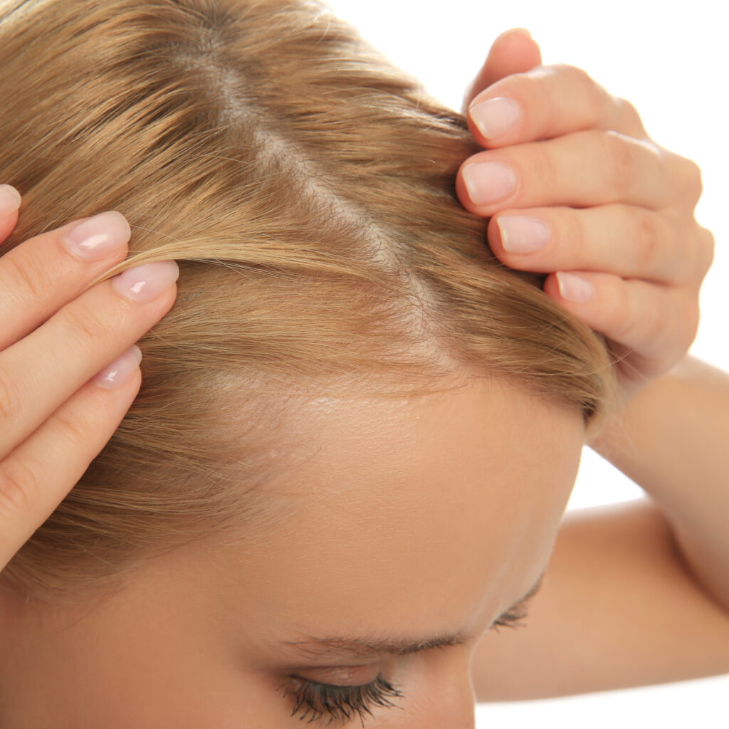 Indications for mesotherapy for hair growth