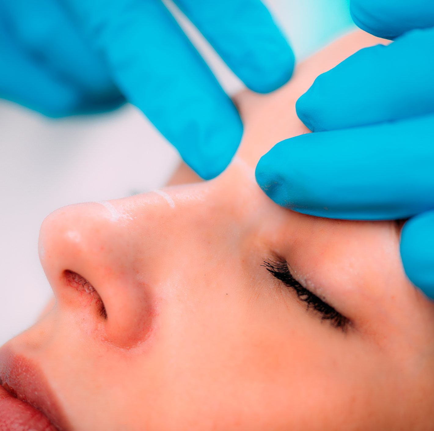 Dermal Fillers