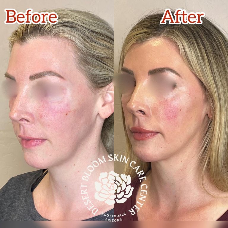 Before & after | Facial optimization with dermal fillers