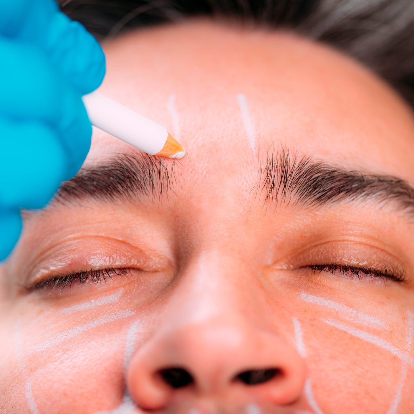 Dermal filler treatment for men to define the jawline and chin