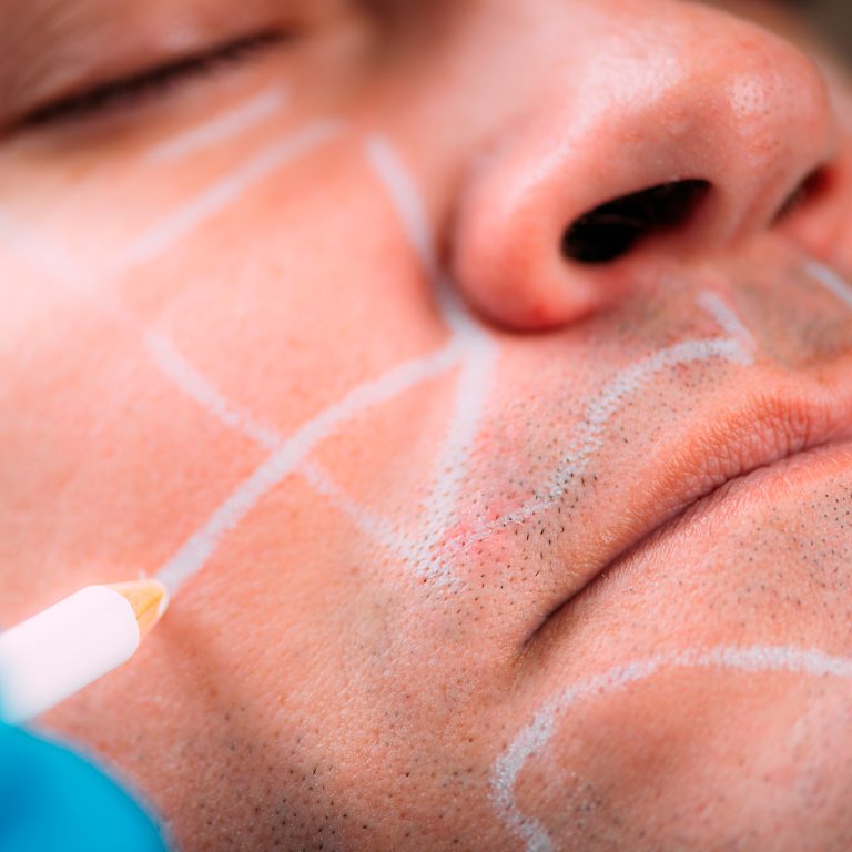 Facial-Contouring-for-men