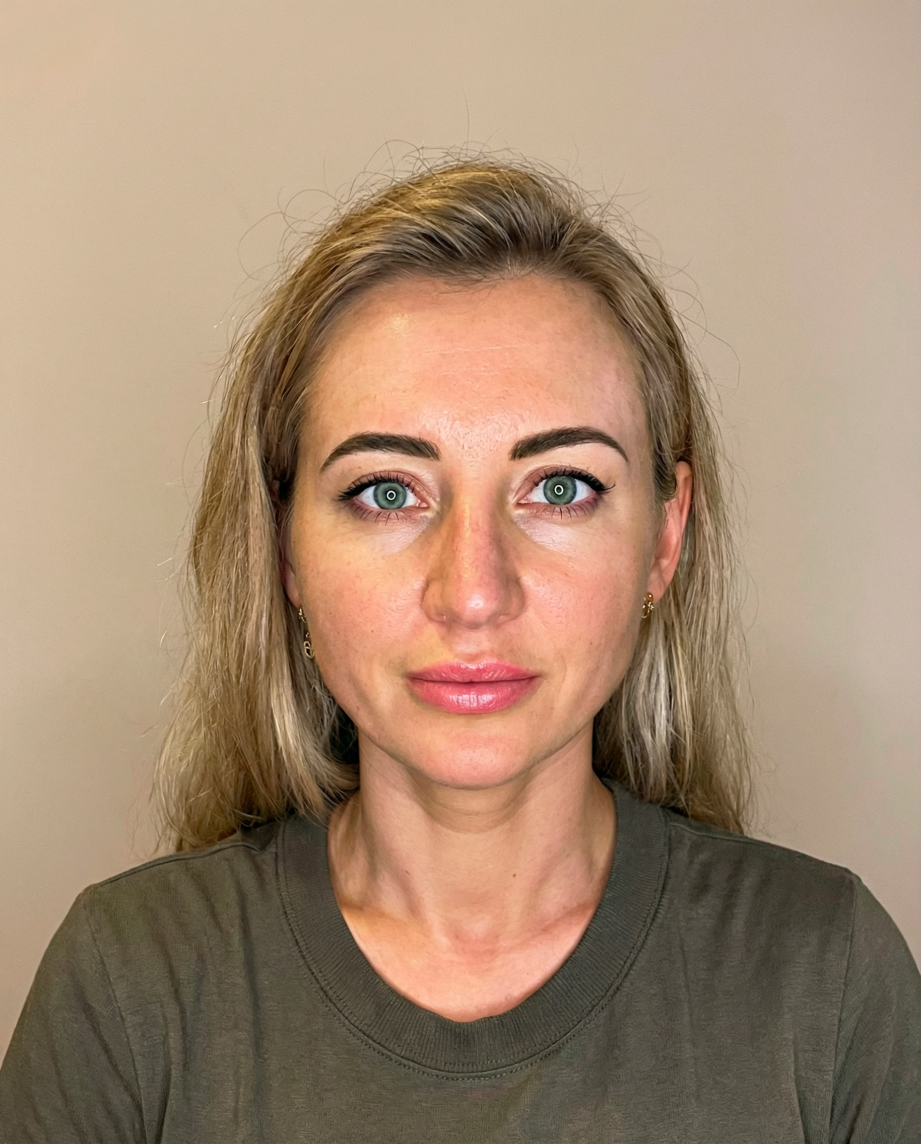 37-year-old woman in Scottsdale before thread lift treatment for facial fatigue (front view)