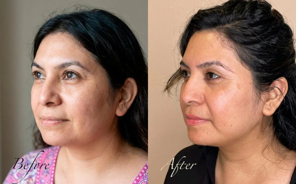 Before-and-after 3/4 view photos of a 43-year-old Hispanic woman after non-surgical jawline contouring with thread lifting