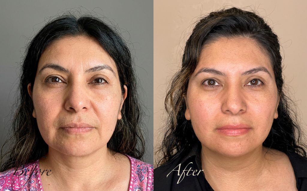Before-and-after front-view photos of a 43-year-old Hispanic woman after non-surgical jawline contouring with thread lifting