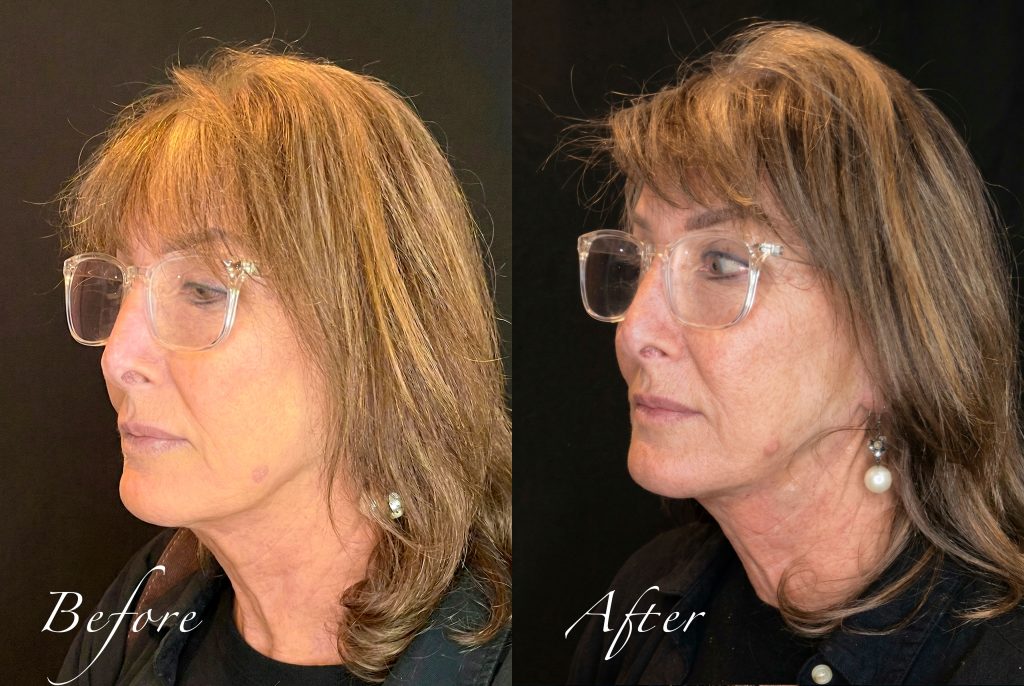 Three-quarter left profile before and after PLLA thread lift for jawline definition.