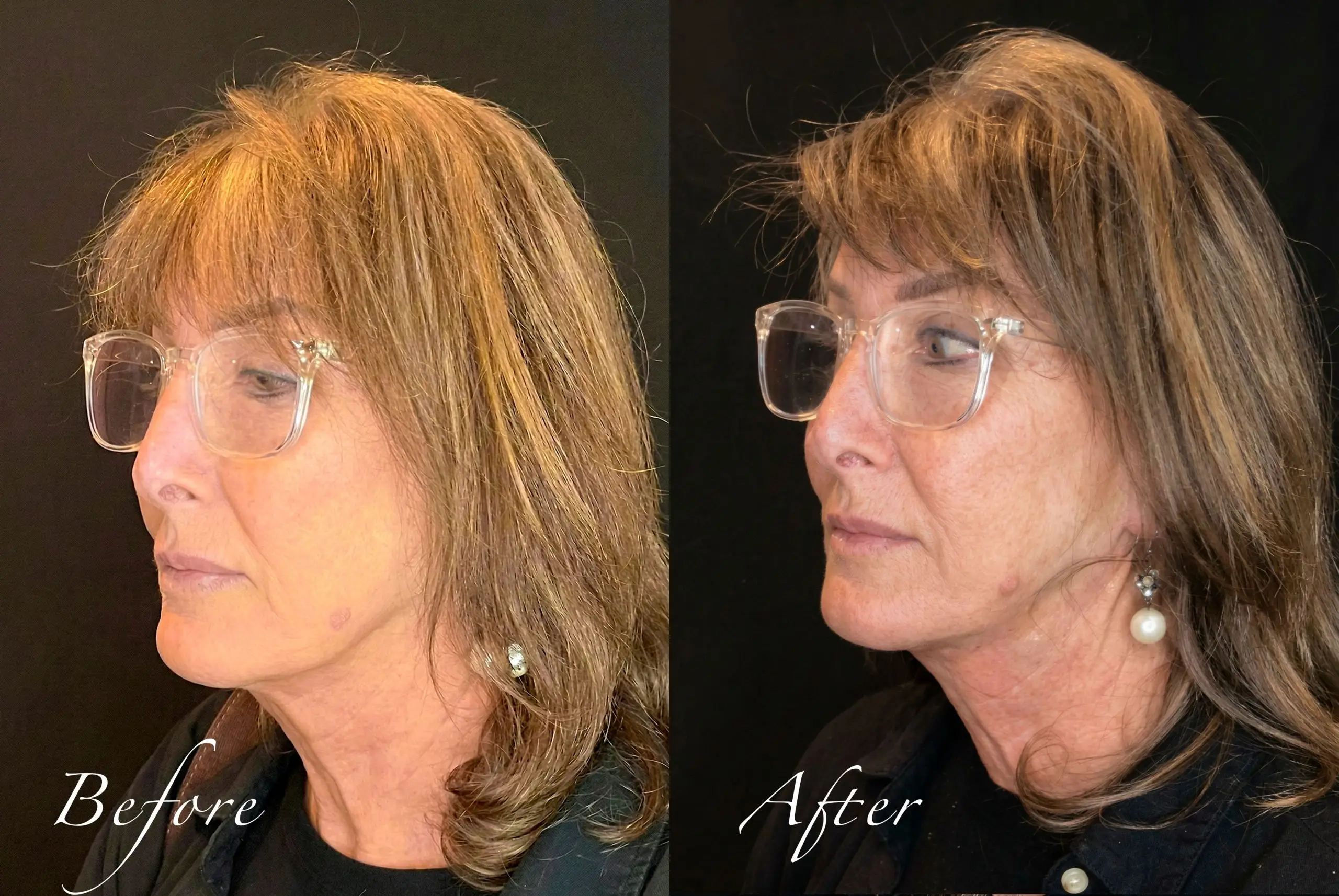 Three-quarter left profile before and after PLLA thread lift for jawline definition