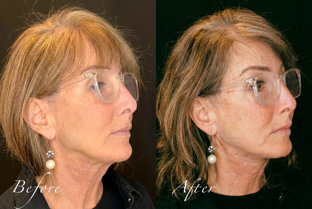 Three-quarter right profile showing corrected submental laxity and improved lower face contour.