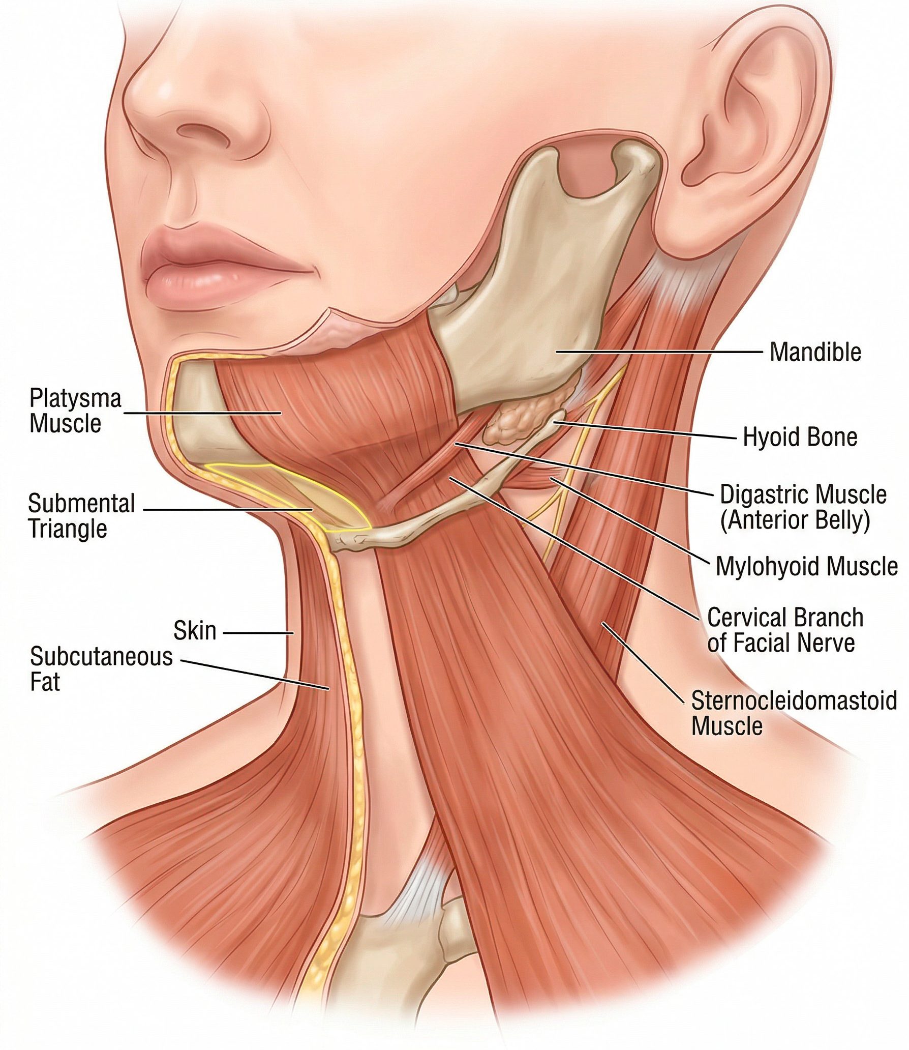 Anatomical diagram showing platysmal laxity and sagging neck skin structures in a mature patient.