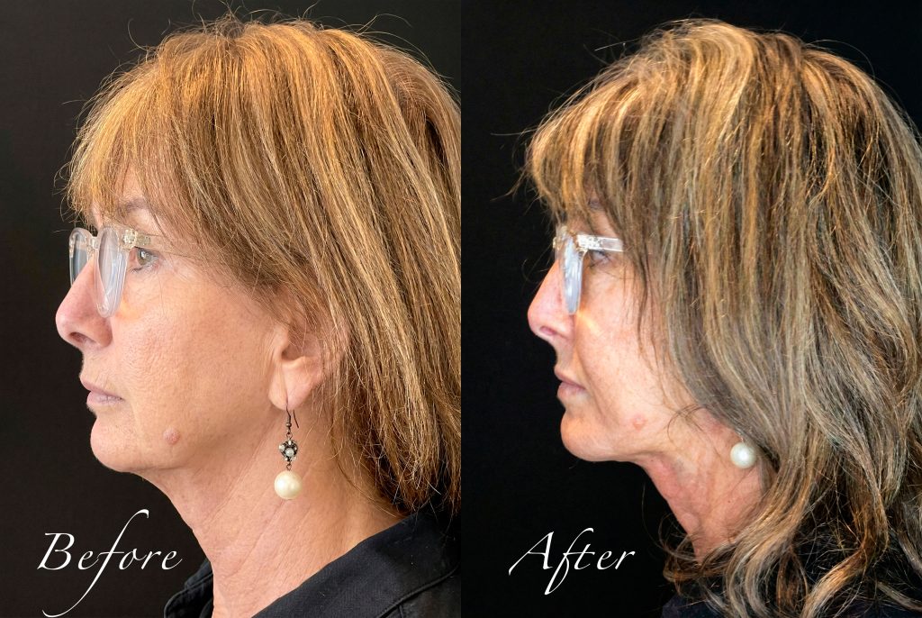 Before and after left profile view of a non-surgical neck lift showing improved submental angle