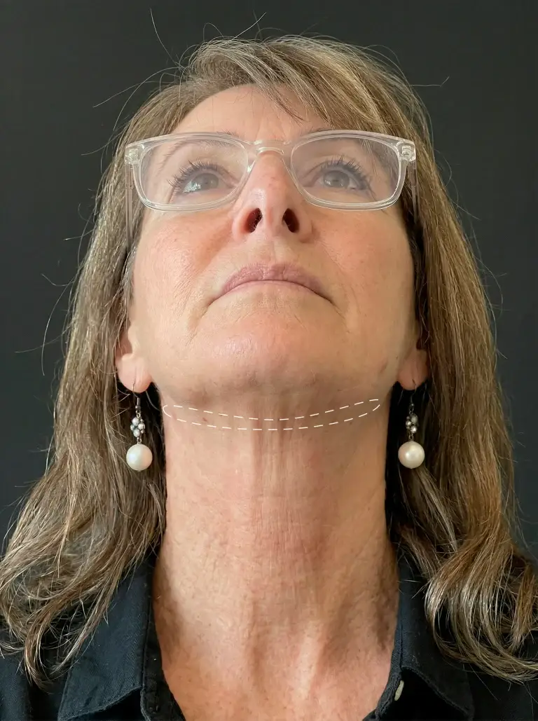 Structural Lower Face Lift: A Case Study in Professional Neck Rejuvenation