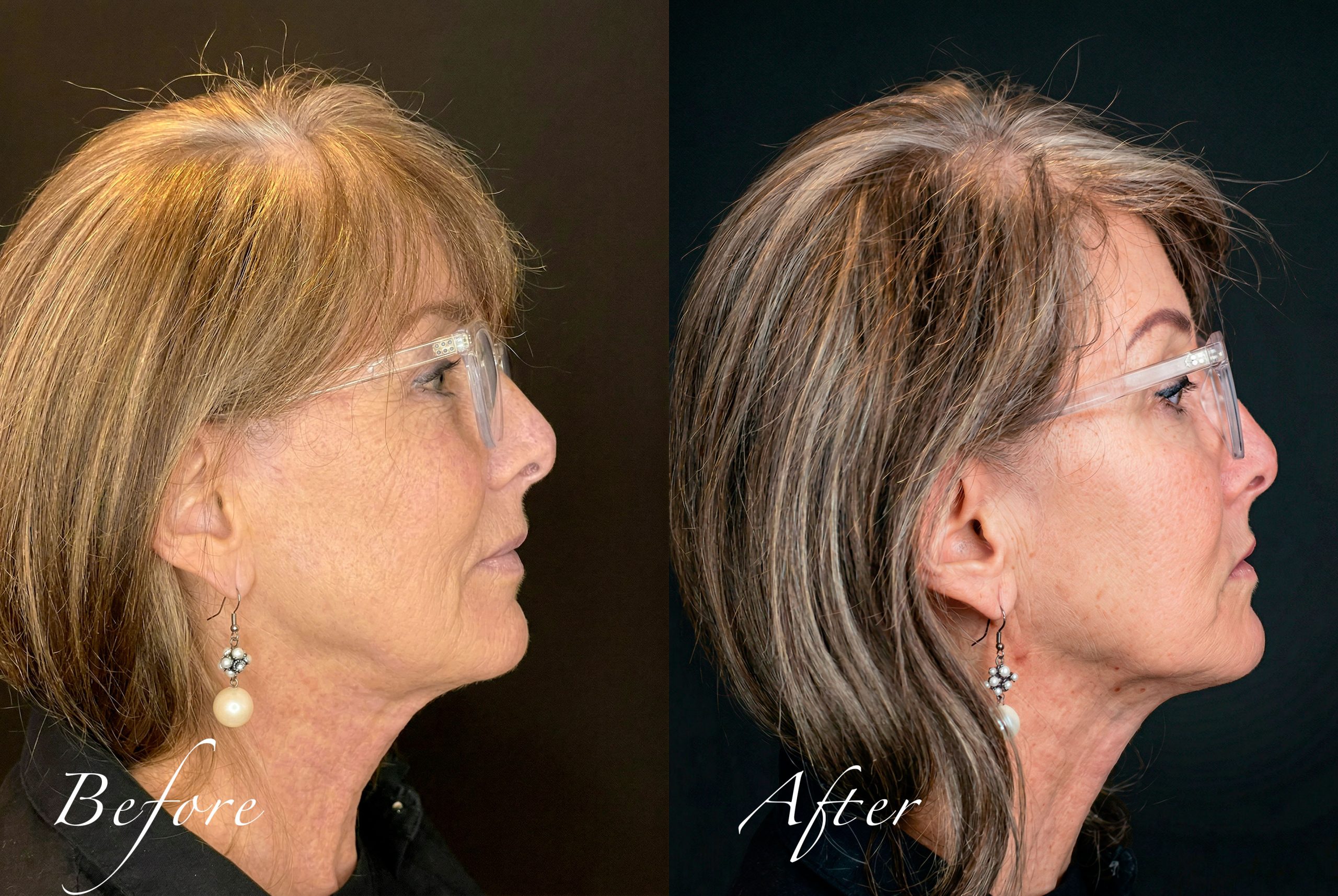 Right profile before and after results of structural neck rejuvenation and jawline tightening