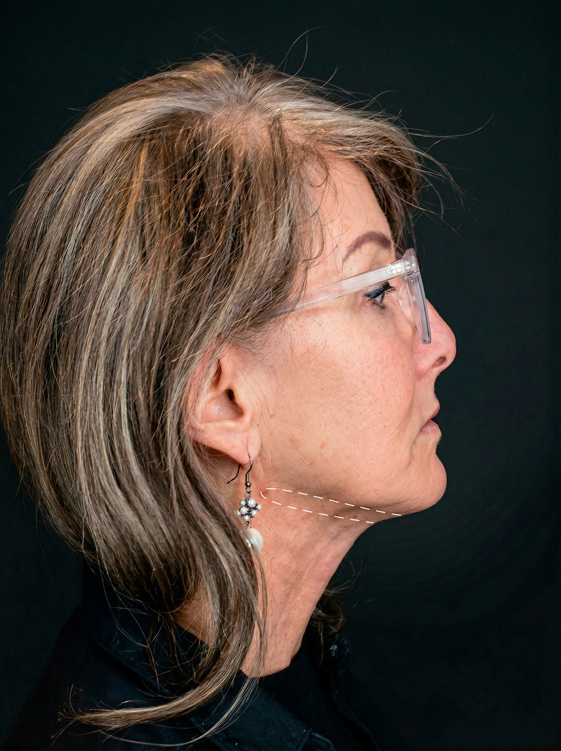 Precise markings of PLLA thread entry points for non-surgical jawline definition.