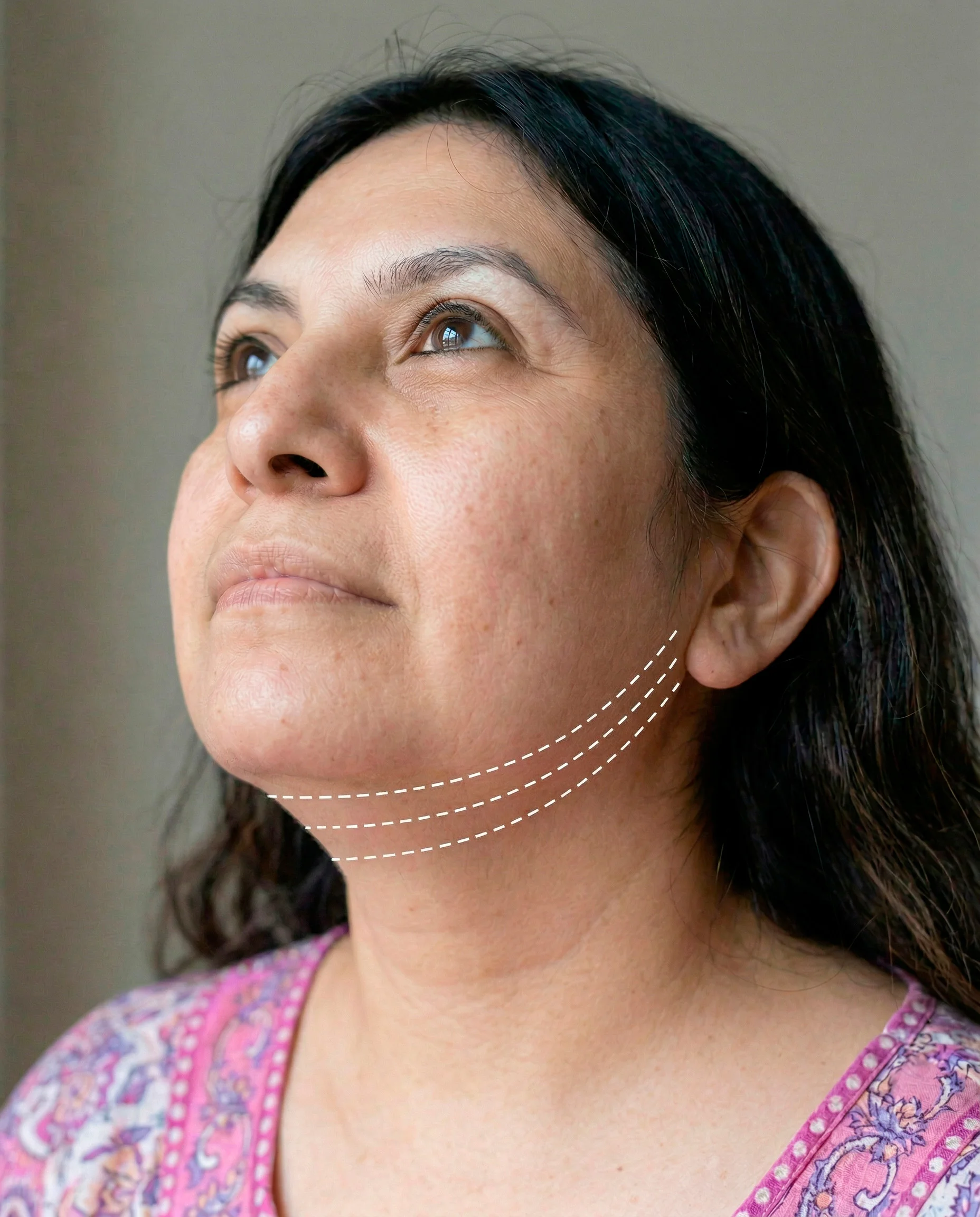 Pre-treatment photo of a 43-year-old Hispanic woman with marked thread-lifting vectors along the jawline and under-chin area