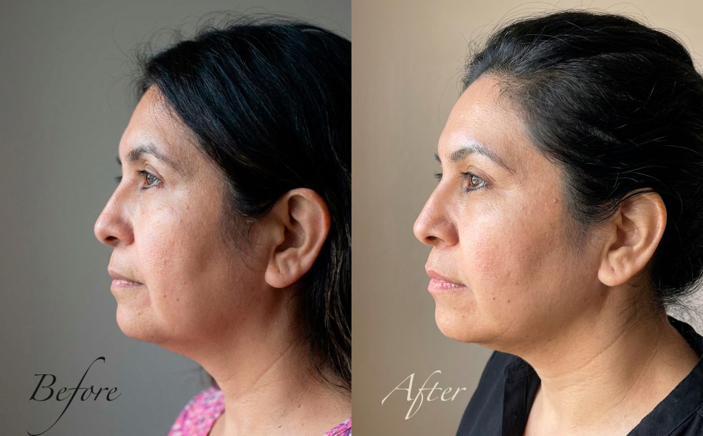 Before-and-after profile photos of a 43-year-old Hispanic woman after non-surgical jawline contouring with thread lifting