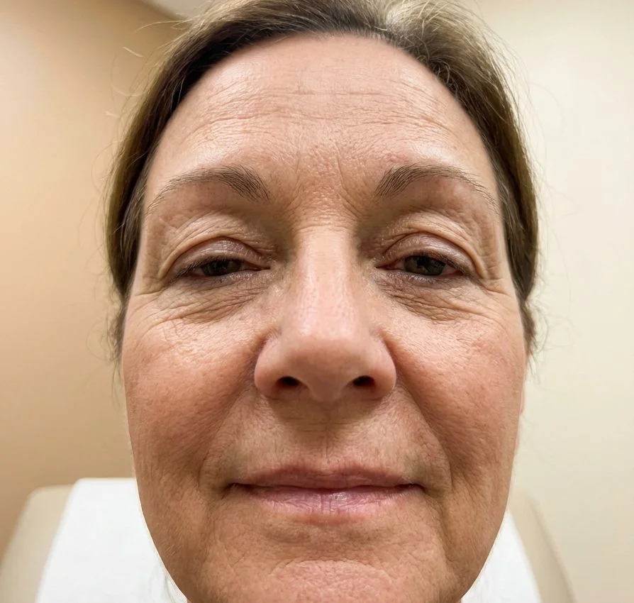 Droopy eyelid ptosis — upper eyelid drooping over iris