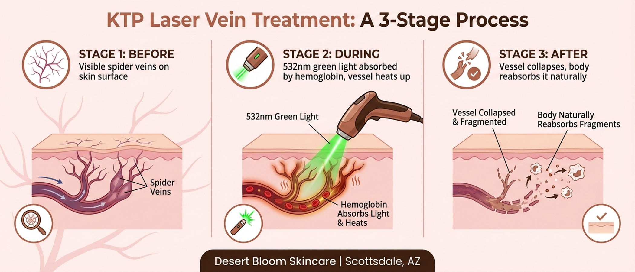 How KTP 532nm laser selective photothermolysis targets hemoglobin in blood vessels