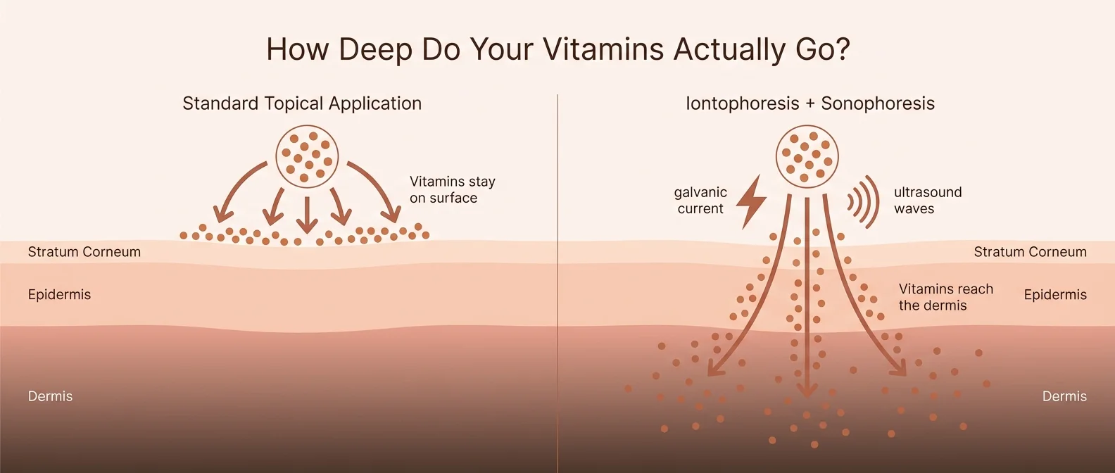 Iontophoresis skin penetration diagram — vitamins reaching dermis vs topical surface application