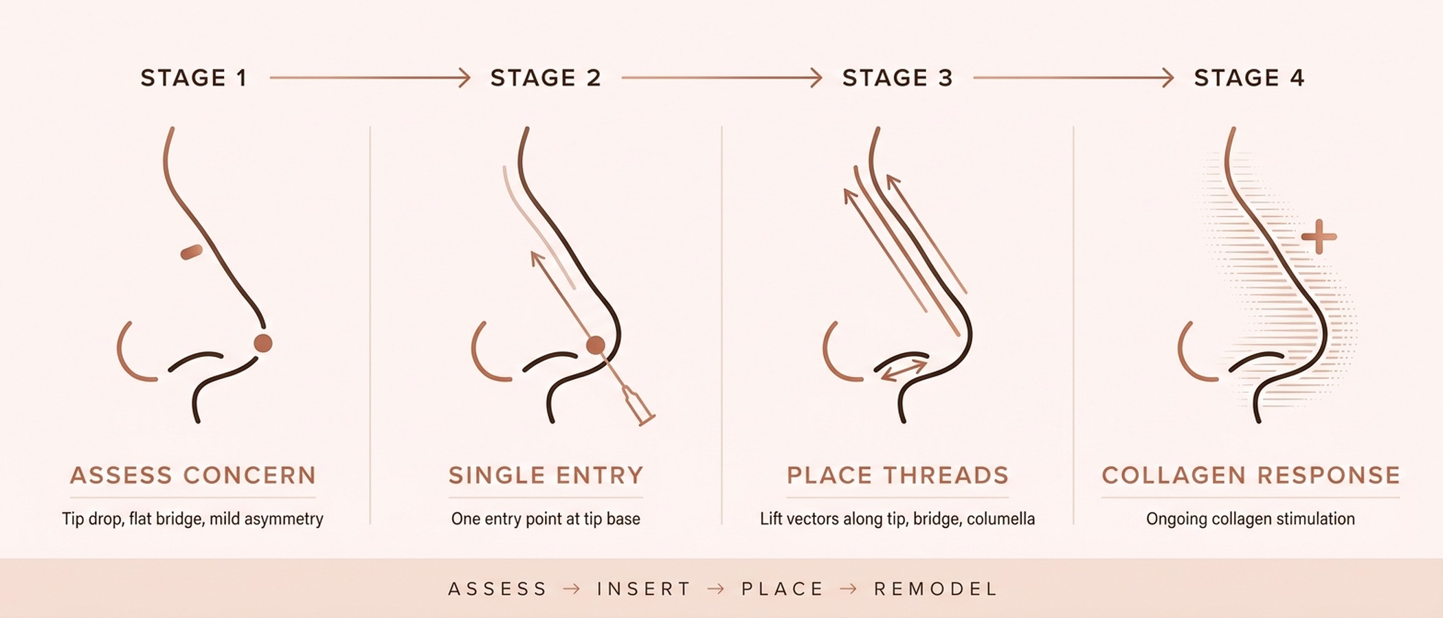 PDO nose thread lift procedure — four-stage process from concern to collagen response