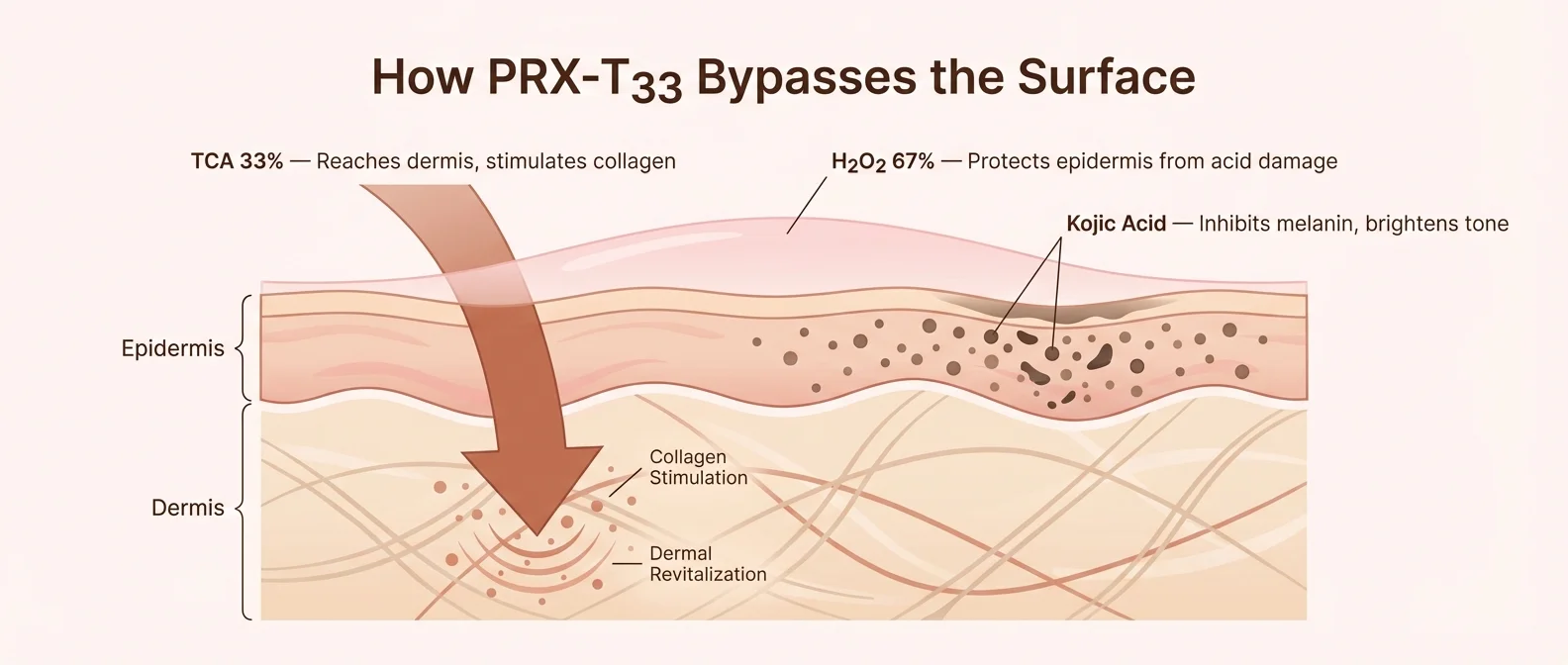 PRX-T33 mechanism — TCA penetrates dermis while hydrogen peroxide modulates epidermis