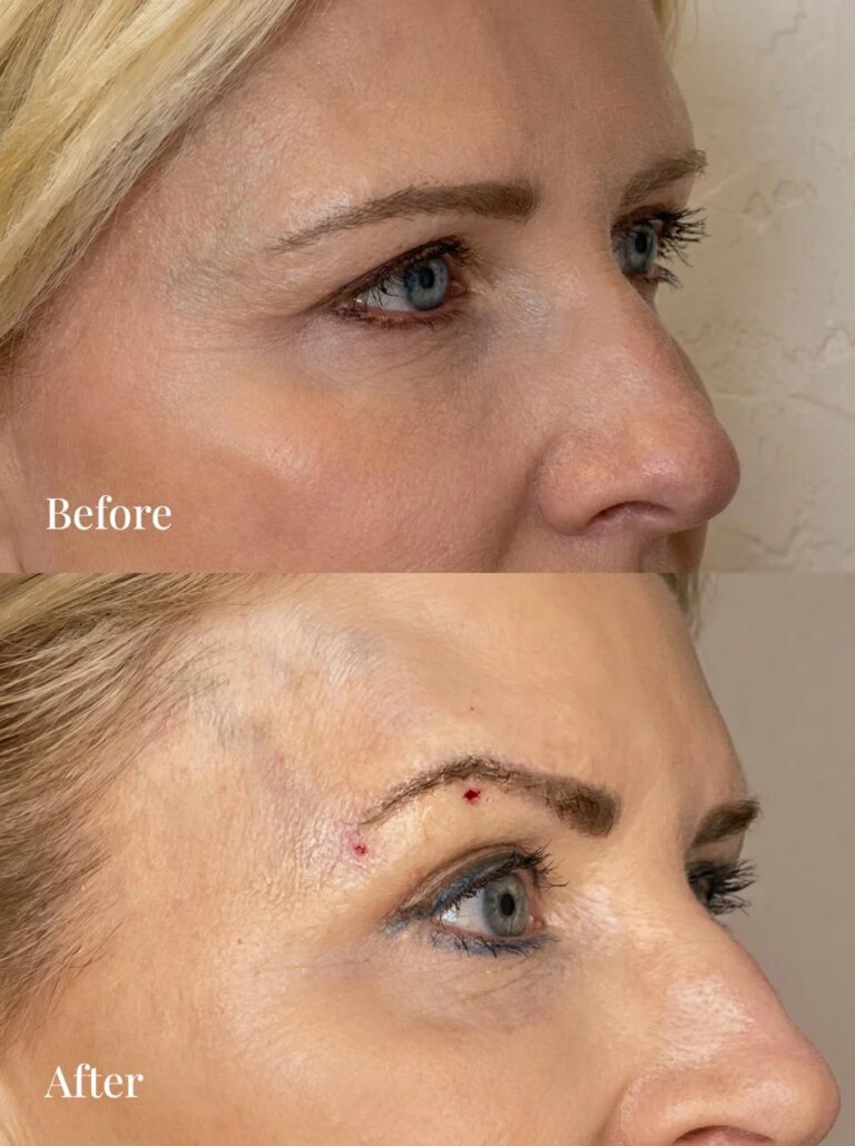 Brow lift before and after — multiple views, Desert Bloom Skincare, Scottsdale