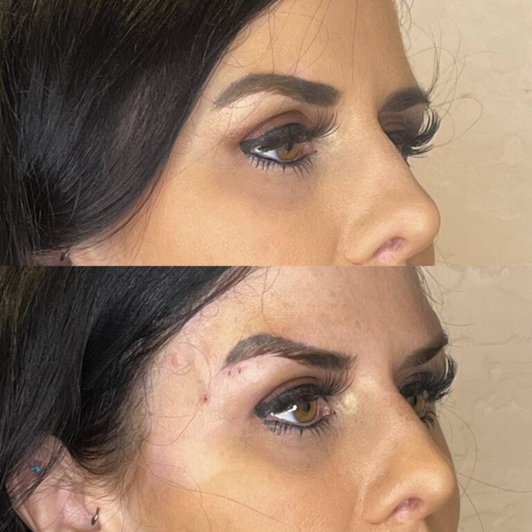 Brow lift before and after — three-quarter view, Desert Bloom Skincare, Scottsdale