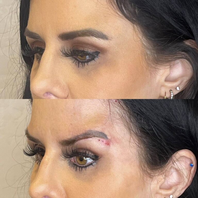 Brow lift before and after — three-quarter view, Desert Bloom Skincare, Scottsdale