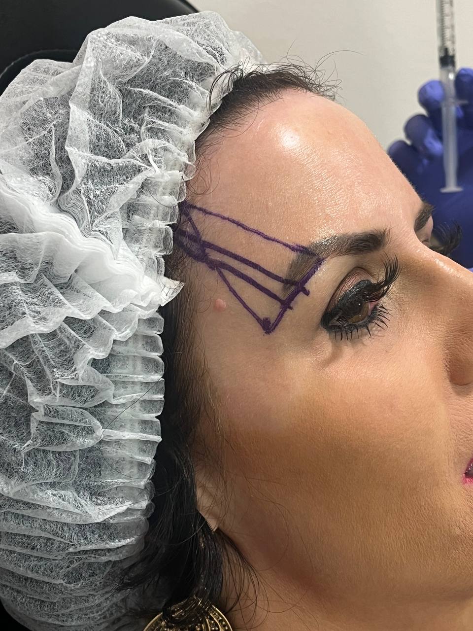 Pre-procedure planning for non-surgical brow lift with purple vector marks indicating thread paths
