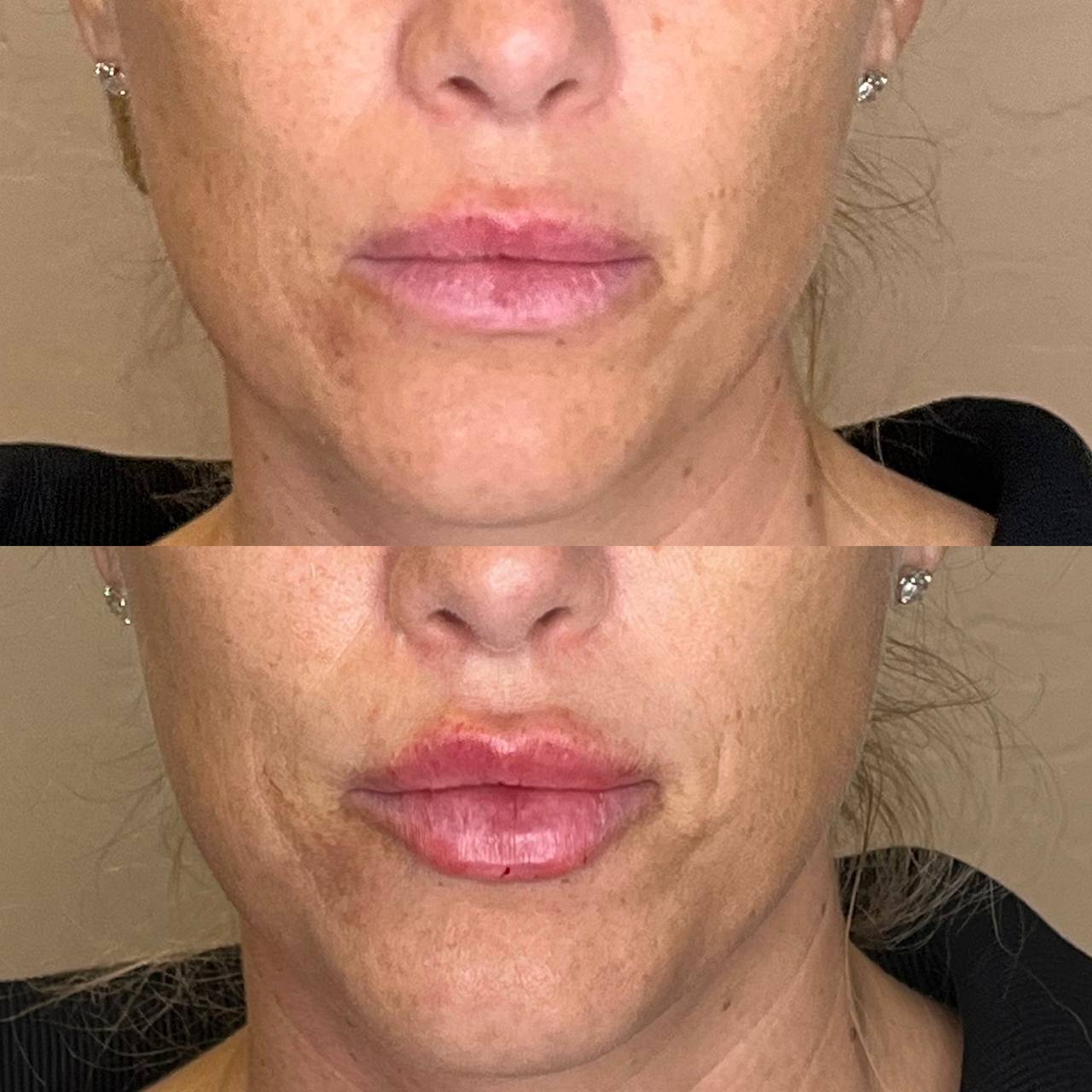 Before and after lip augmentation, mature patient, Desert Bloom Scottsdale