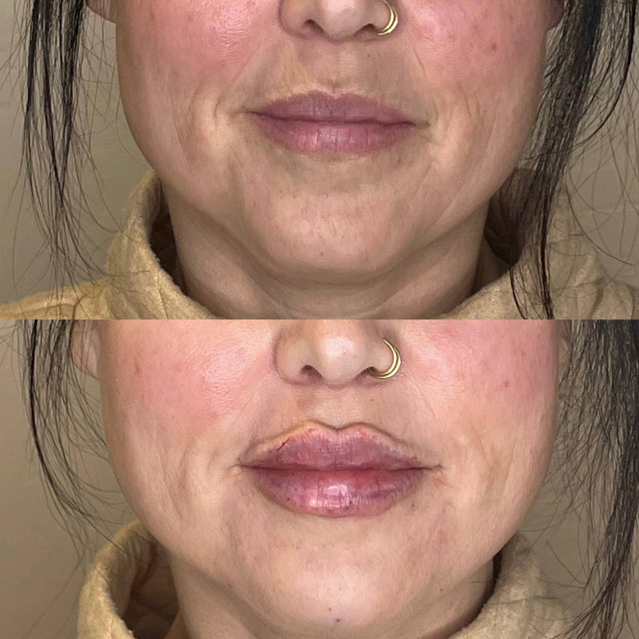 Before and after lip filler improving philtrum and lip border