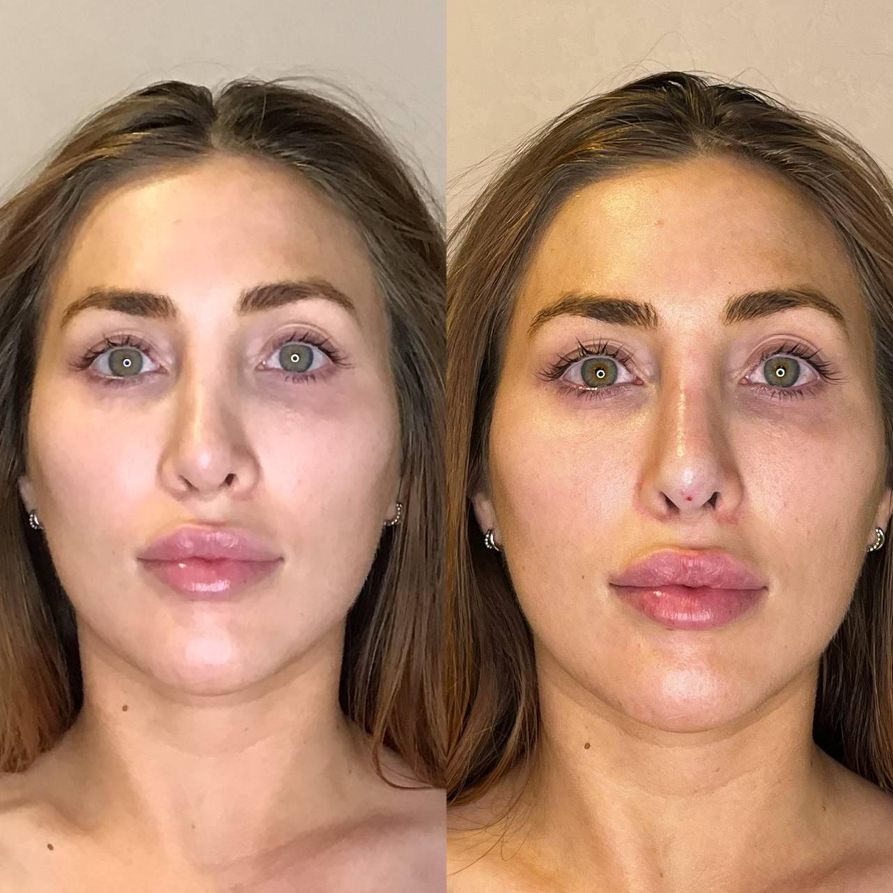 Nasal Tip Correction After Surgical Rhinoplasty