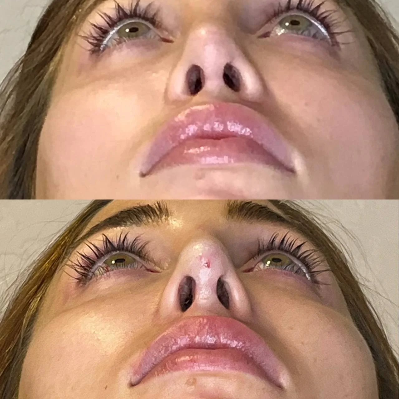 Nasal Tip — Under-Nostril View