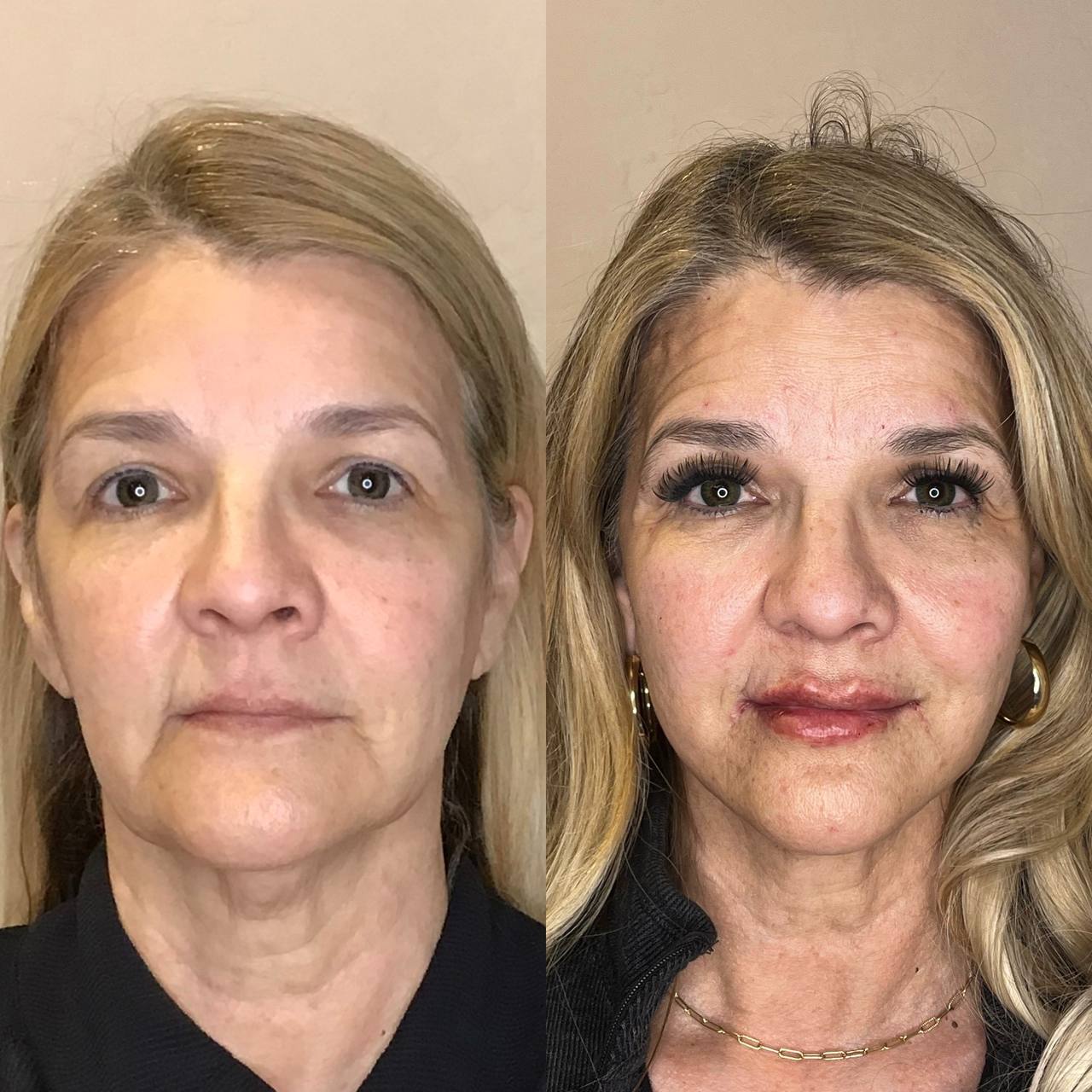 Face & Neck Lift with Lip Filler