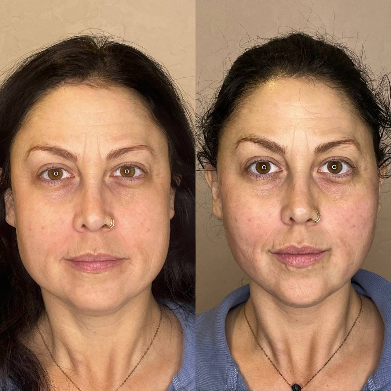 PDO Thread Lift Face