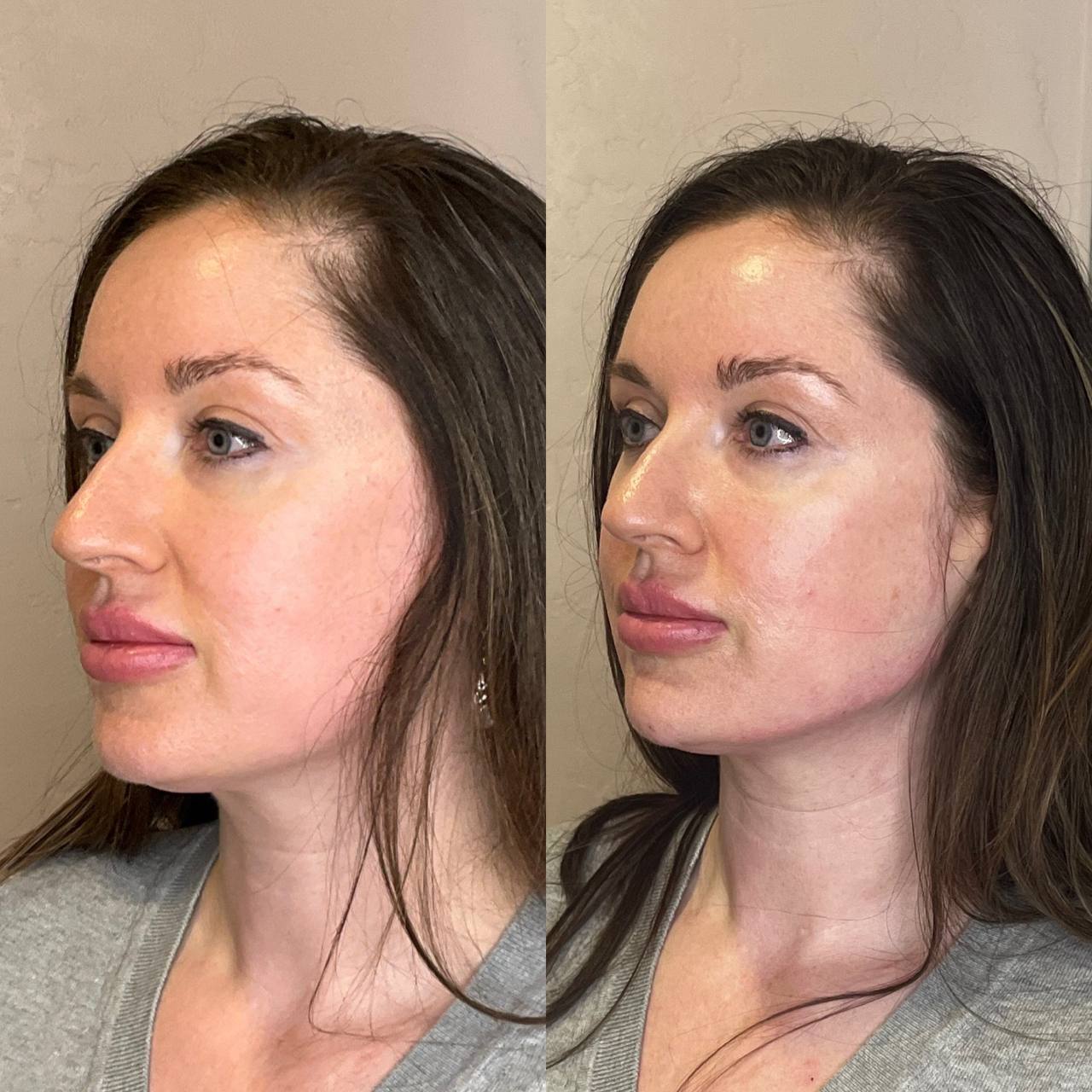 Before and after profile balancing with dermal fillers, alternate three-quarter view — before