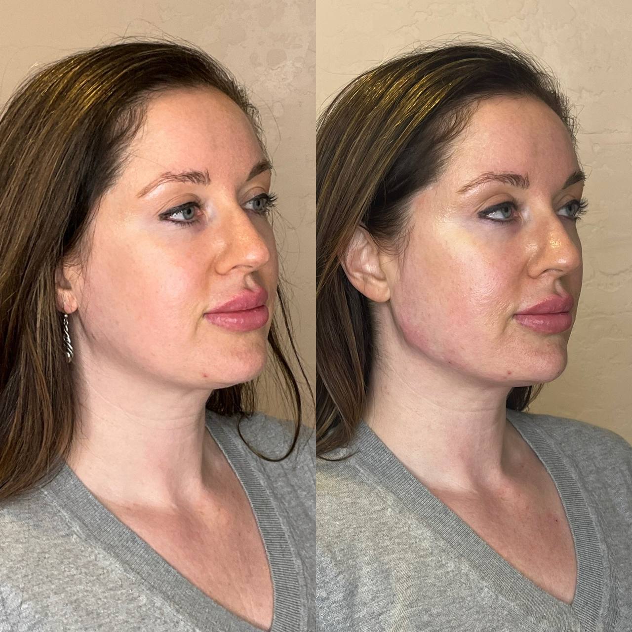 Before and after profile balancing with cheek and chin filler, three-quarter view — before