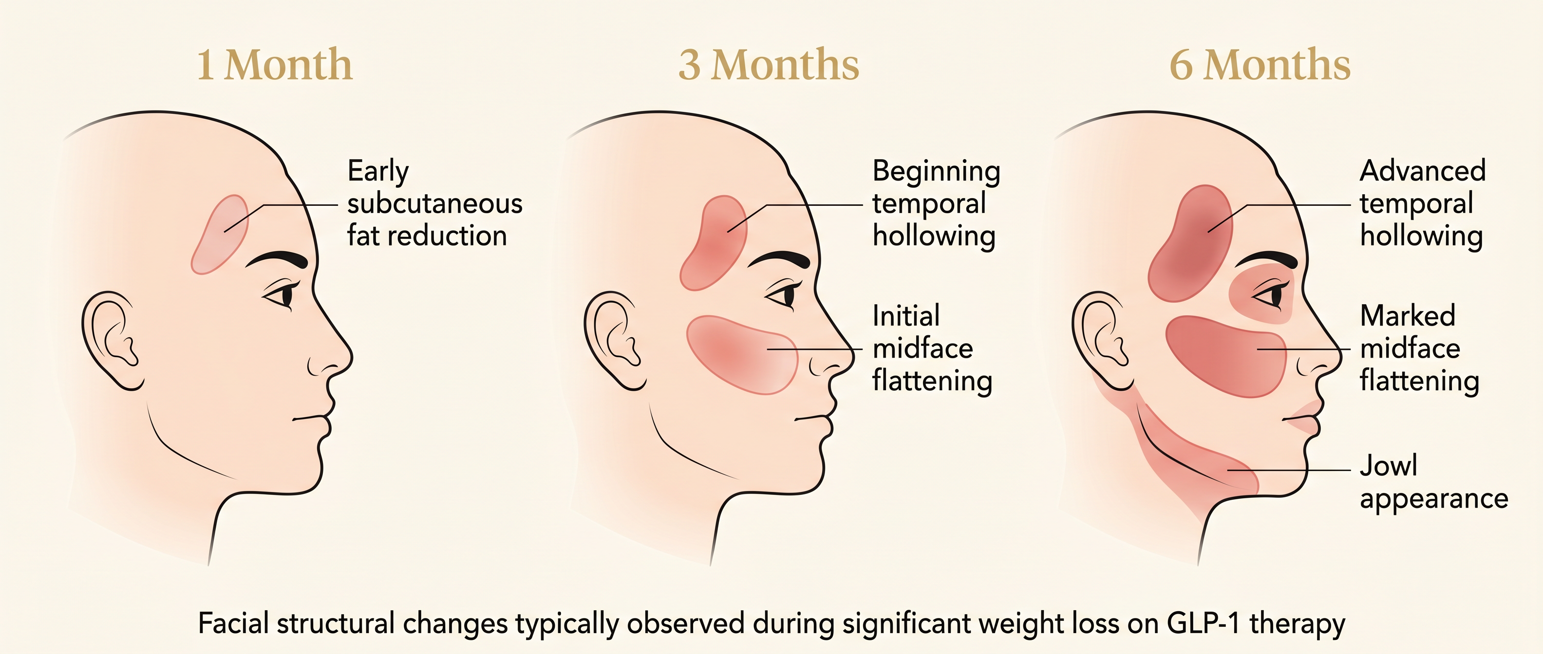 Timeline of facial structural changes at 1, 3, and 6 months of rapid GLP-1 weight loss — temporal hollowing, volume loss, skin laxity