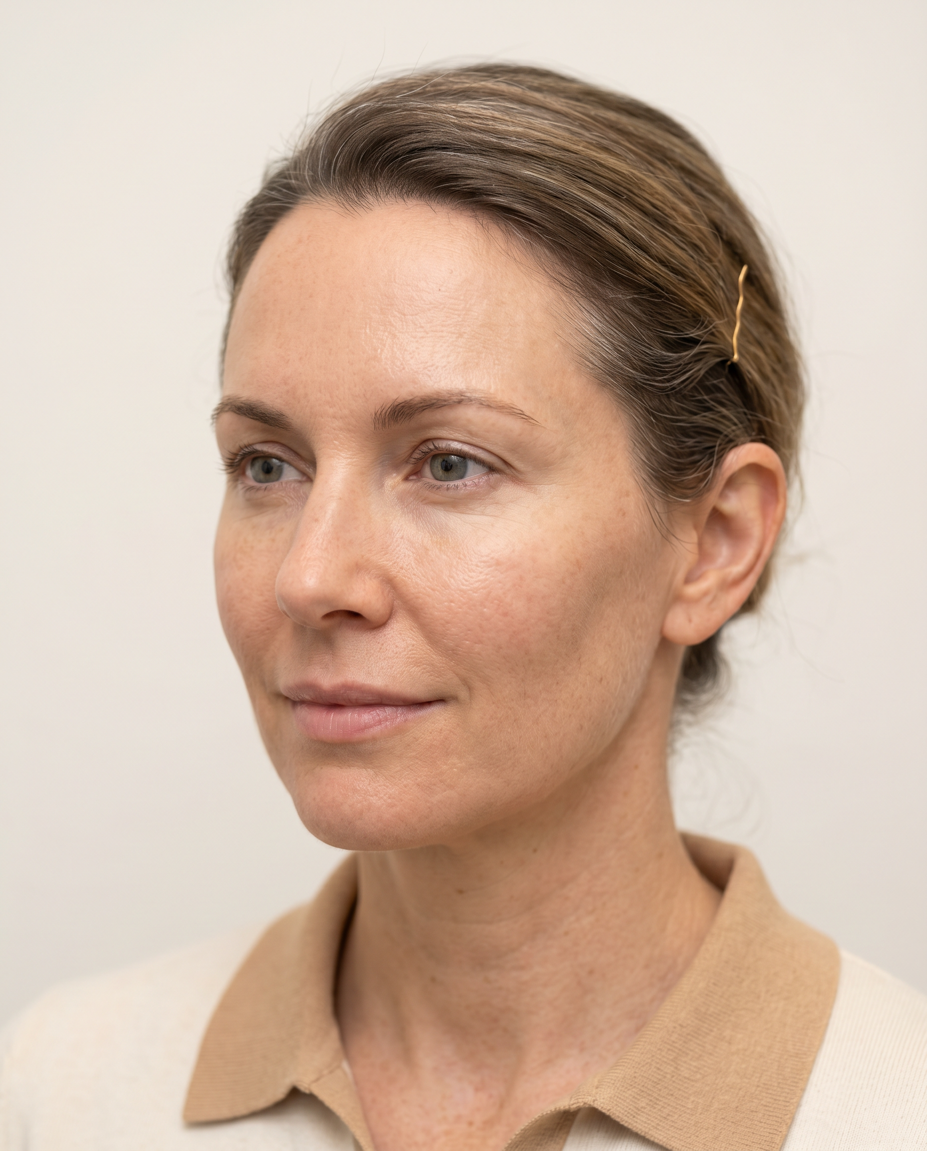 Woman with restored midface volume — dermal filler treatment for facial volume loss from GLP-1 weight loss medication