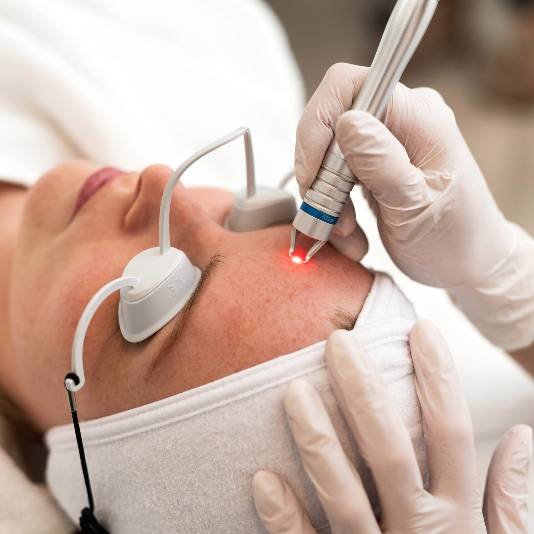 KTP laser treating facial veins and redness at Desert Bloom Skincare, Scottsdale