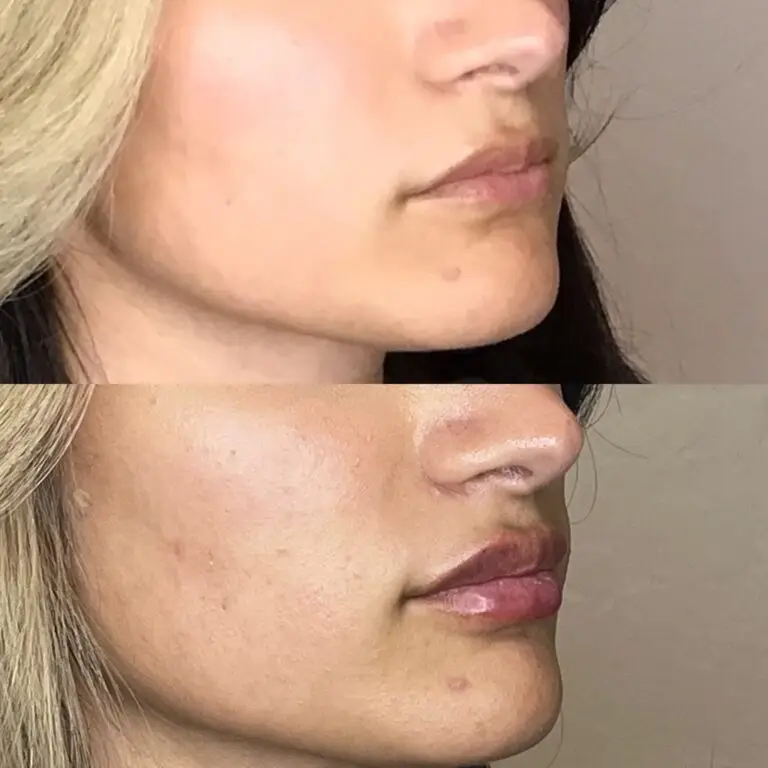 Desert Bloom patient — Lip filler result, case 1